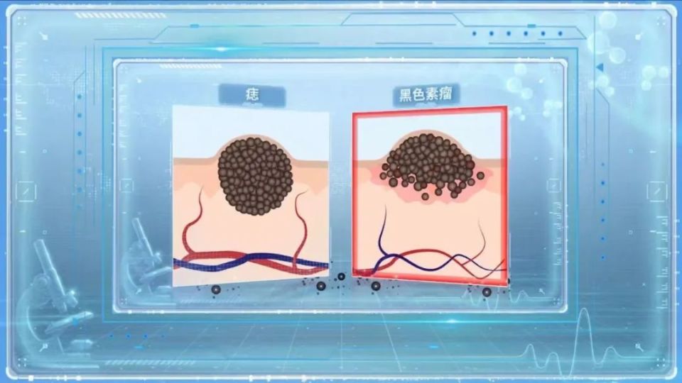 你身上有"危险的痣"吗?