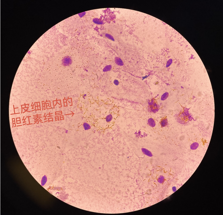 胆红素结晶:黄疸尿液中绽开的"金花"朵朵