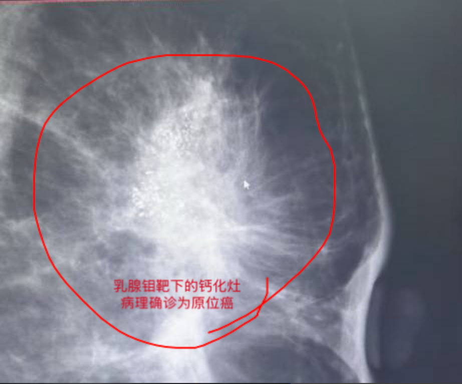 通过精准的钼靶检查发现了患者乳腺内广泛分布的钙化灶,结合影像学