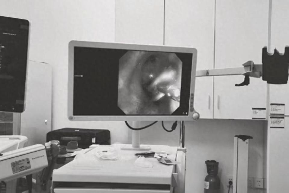 瓜子壳误入"气管歧途",医生纤维支气管镜下"巧"取出