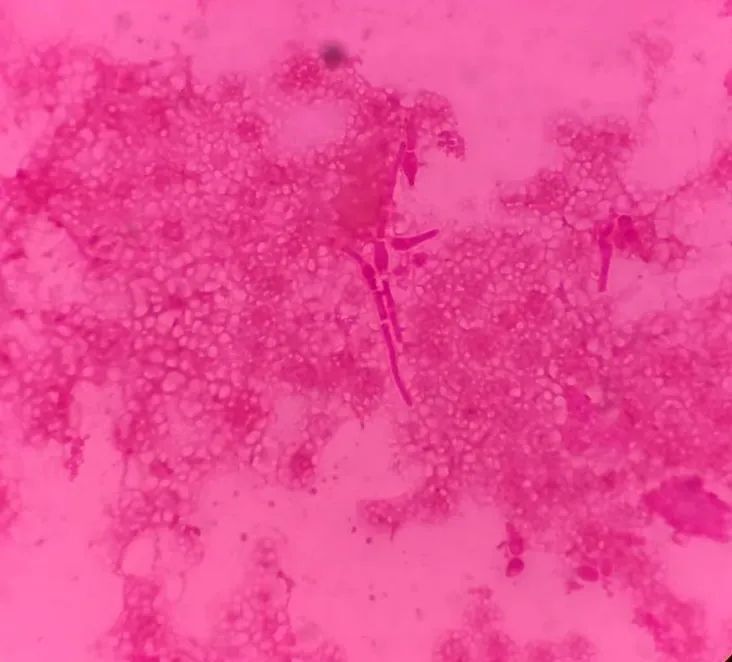 马尔尼菲菌图片