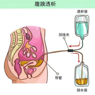 腹膜透析图片卡通图片