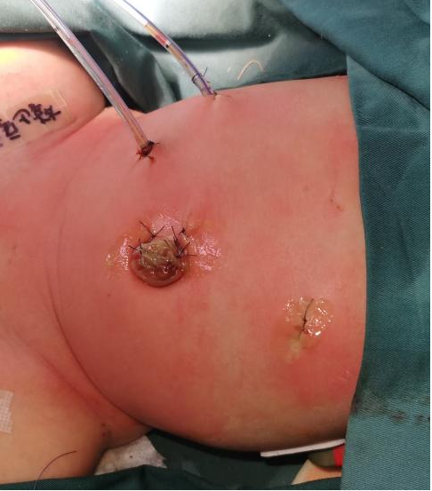 3mm腔镜技术为出生仅5天龄胆总管囊肿患儿带来新希望