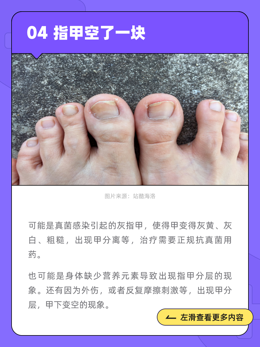 指甲黄黄的,还变厚了不少,是灰指甲吗?