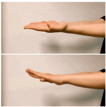 伸出一只手,食指和拇指做对指的动作,幅度尽量大,频率尽量快,帕金森的