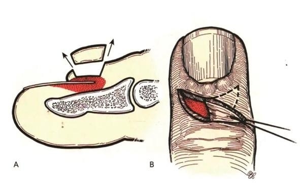 指甲剪太短小心甲沟炎