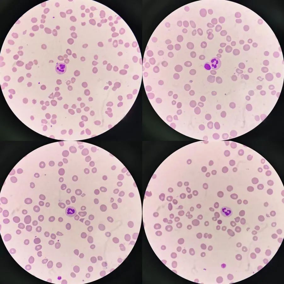 2,外周血涂片检查:红细胞计数(rbc)和血红蛋白(hb)均低于正常值下限