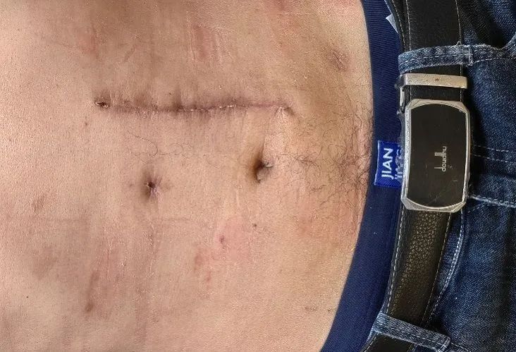 【朝医新闻】泌尿外科实施机器人辅助下腹膜后巨大肉瘤切除术