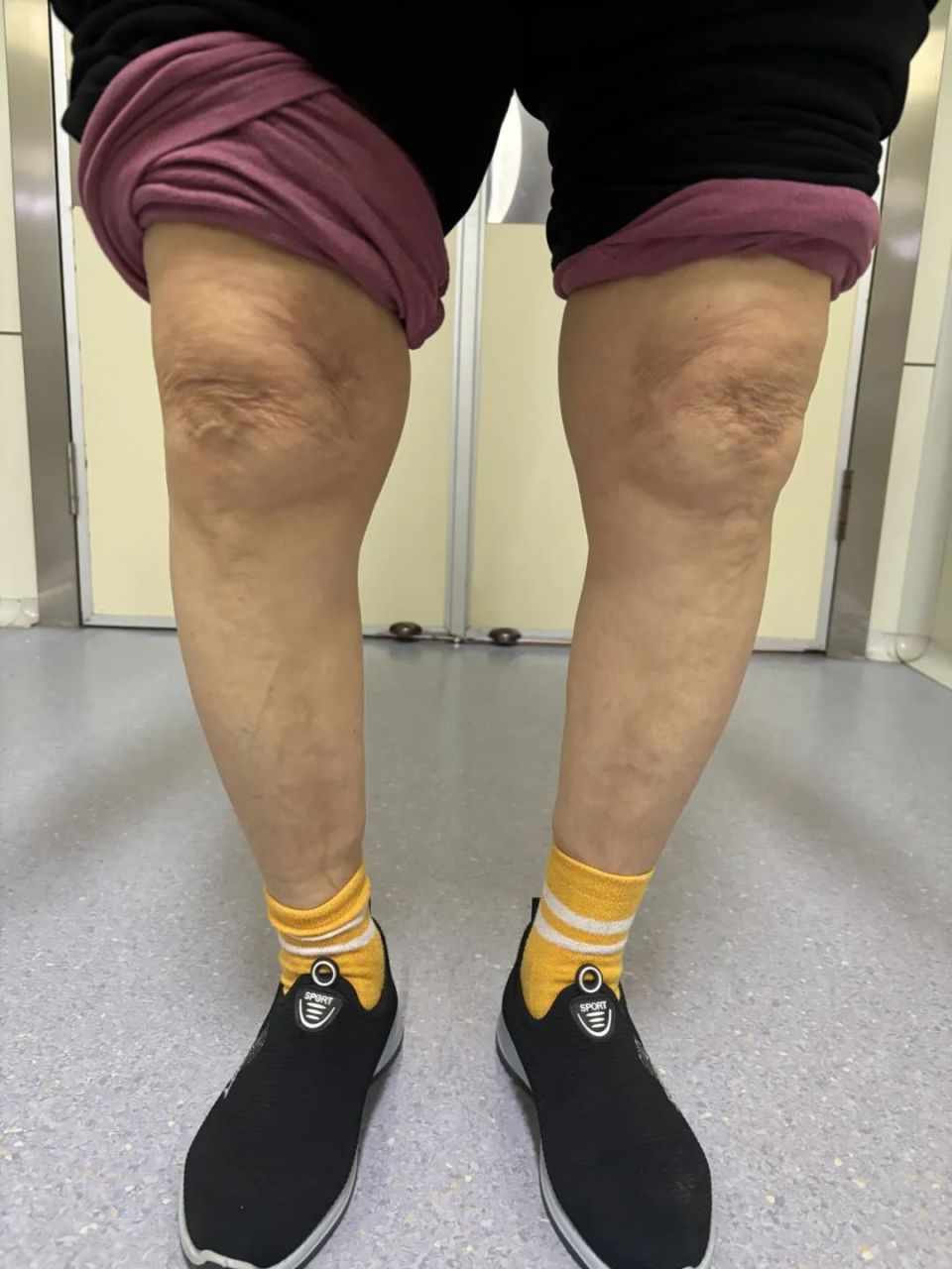 技术前沿∣高龄老人突发急性下肢深静脉血栓,看介入科如何"一站式"