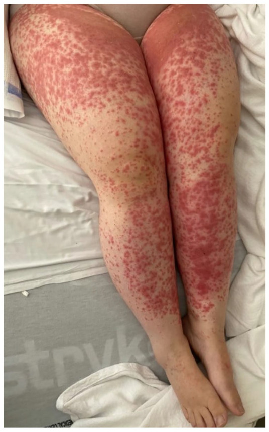 "痘痘"大不同,这11种皮肤病别都当成痤疮来治