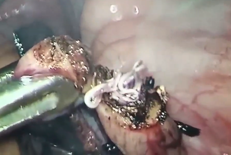 他们都惊呆了,没想到女儿小小的肚子里竟然有那么多的寄生虫!