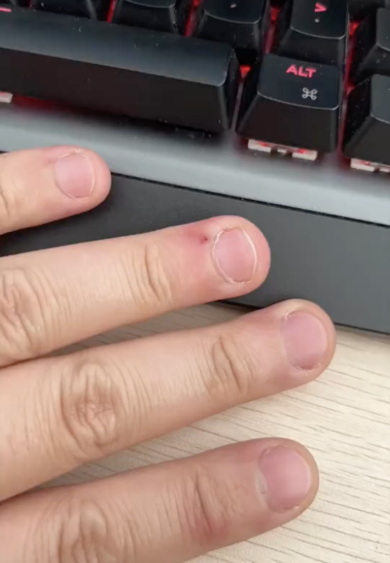 发炎往外滋血缝6针这个坏习惯好多人都有