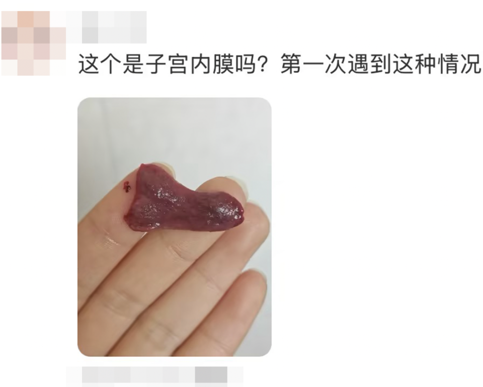 女生月经期掉出超大血块,千万警惕一种情况