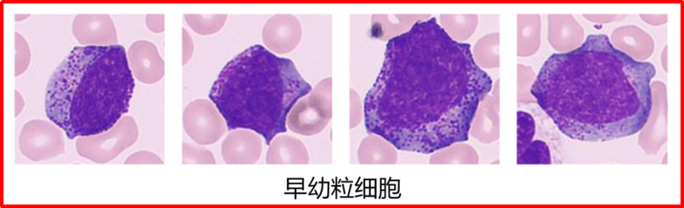 使用升白针后，外周血细胞形态「变形记」！_腾讯新闻