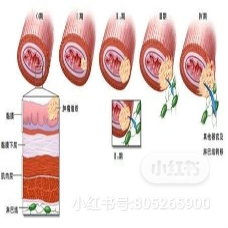 食管癌术后饮食护理措施中正确的是，关于食管癌的知识分享插图4