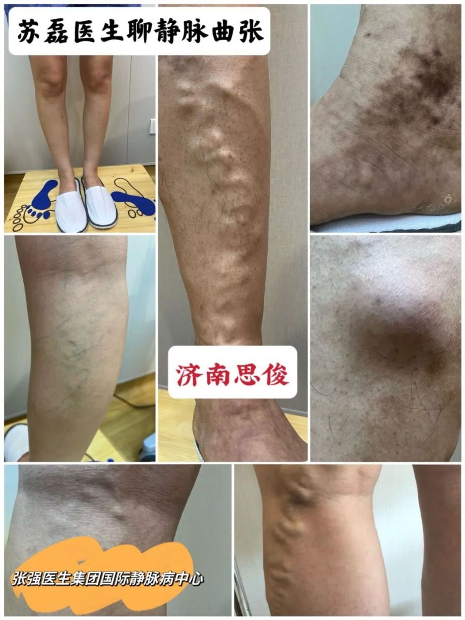 苏磊医生:静脉血栓容易盯上哪些人?