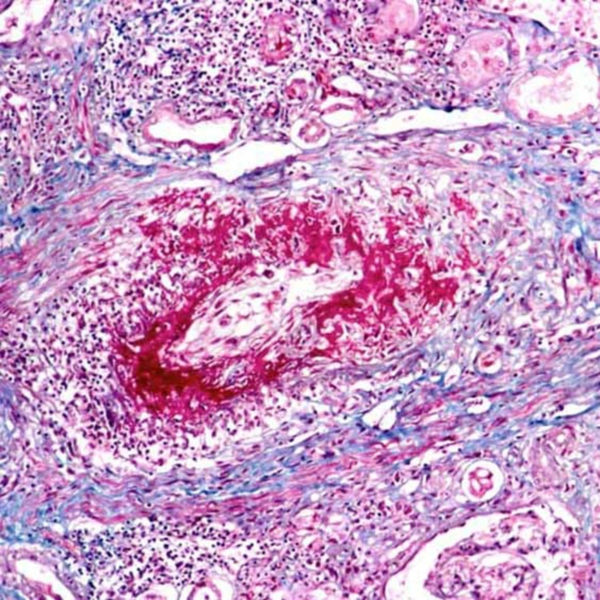 环状纤维蛋白样坏死肾脏小叶间动脉三色染色切片显示环状纤维蛋白样