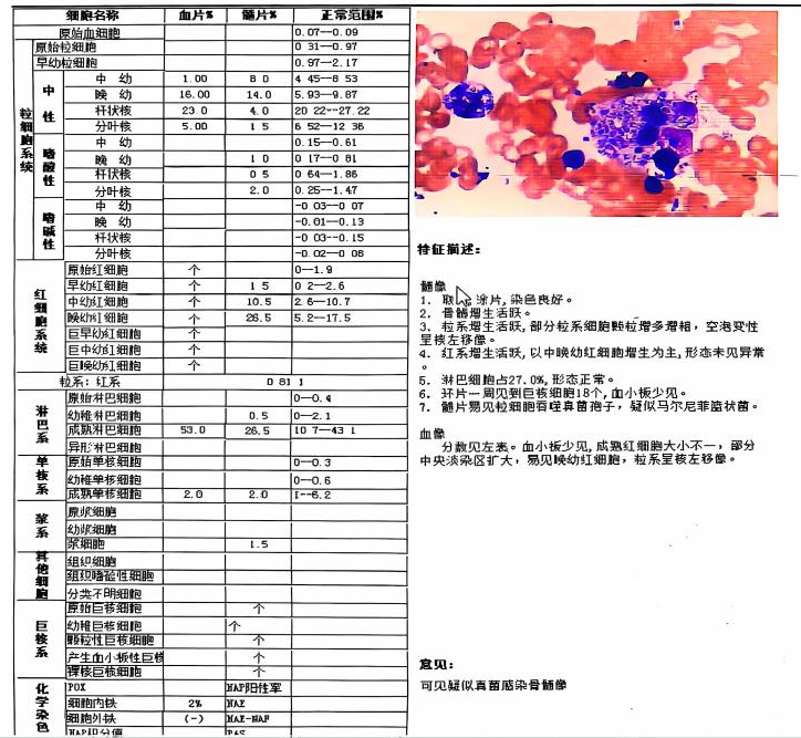 骨髓涂片报告图片