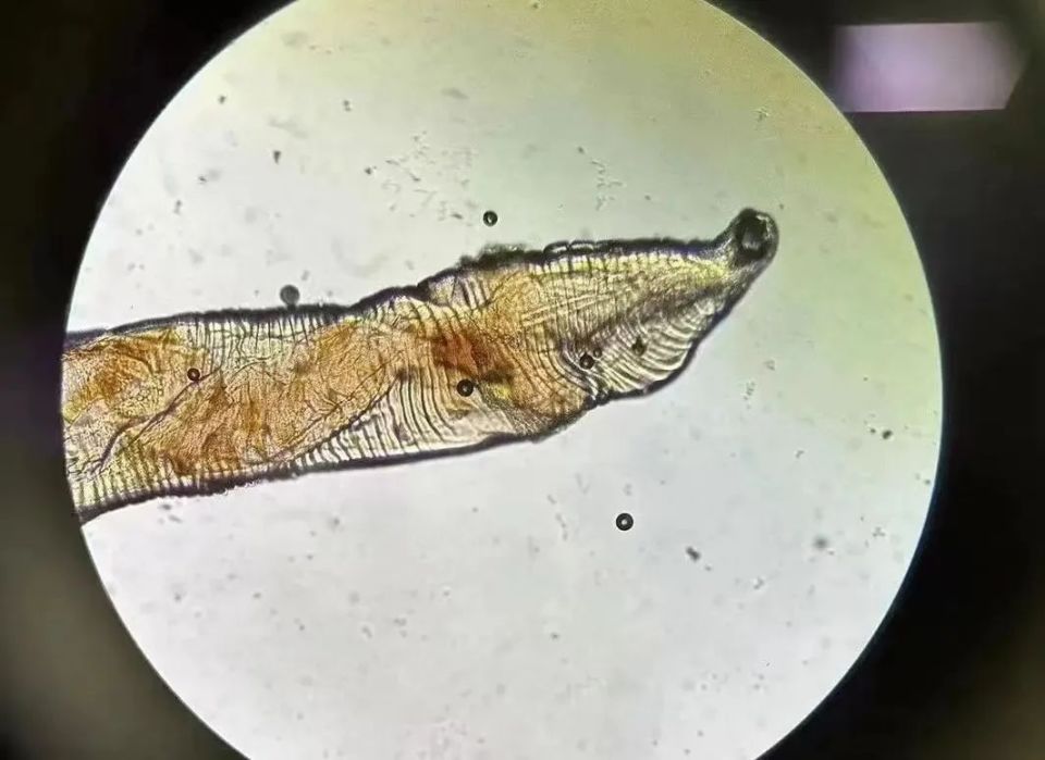 肠子肛门都有虫,还是活的!这些习惯容易"惹祸"