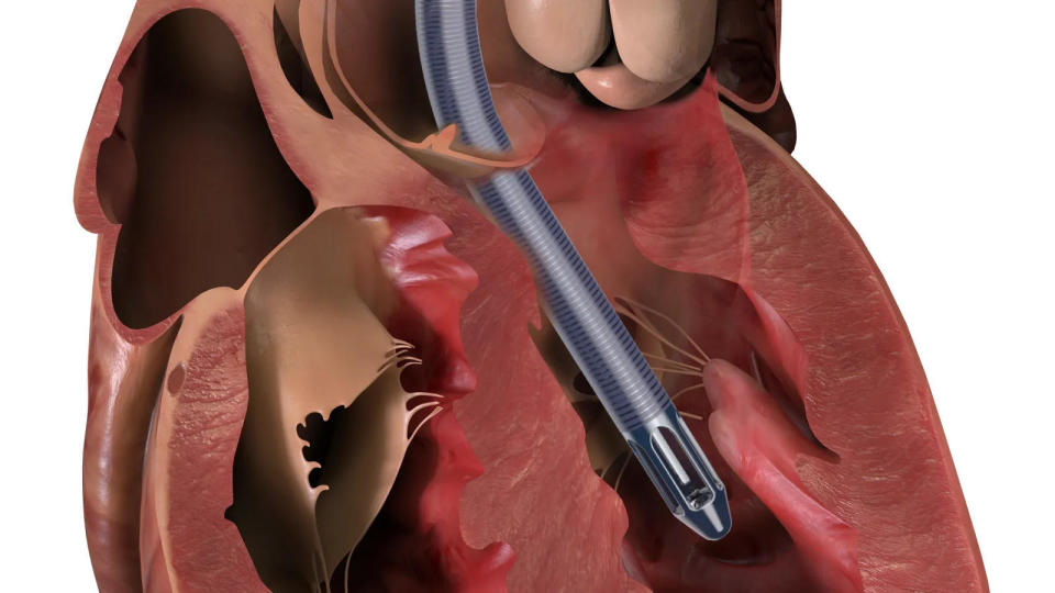 致49死129重伤,美国强生子公司召回介入式人工心脏泵!