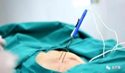 消融电极用于哪些手术肿瘤消融技术，让肿瘤治疗更安全高效！_https://www.jmylbn.com_新闻资讯_第4张