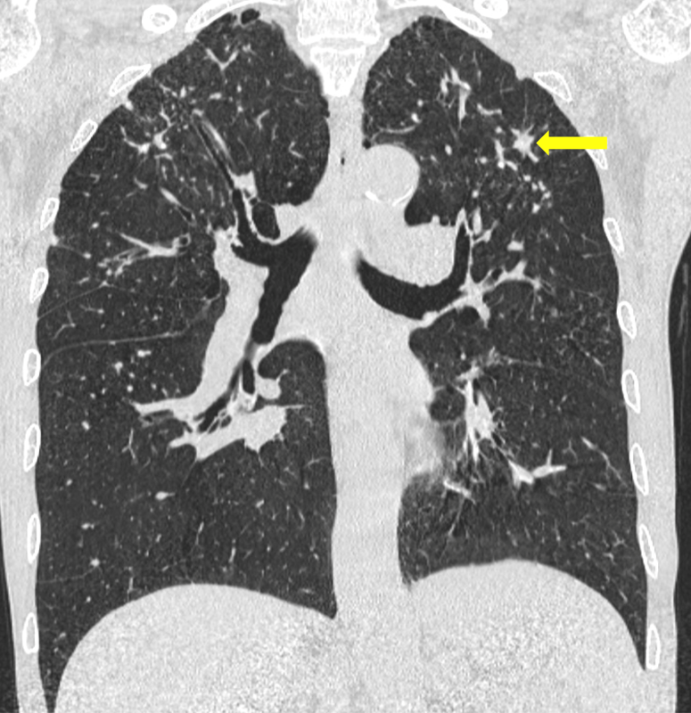 病例分享|肺结节的罕见原因:注意病史,别忽视这个重要信息