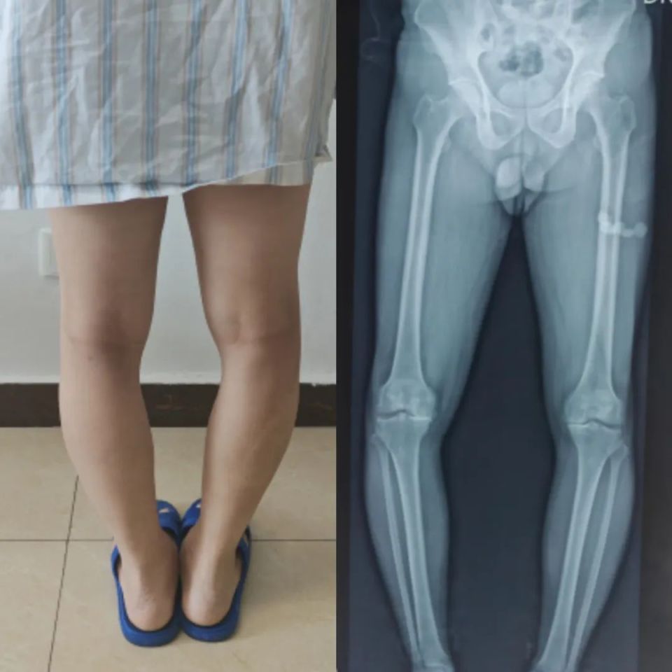 "o"型腿不仅影响美观,也可能是膝关节疼痛的元凶