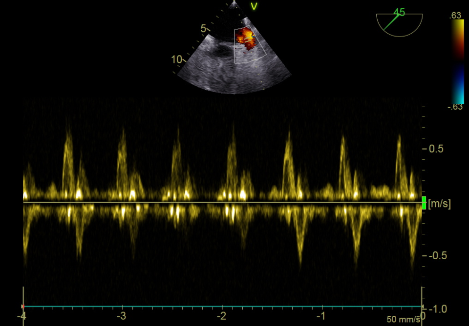 精准救治丨西安市红会医院超声医学科开展首例经食道超声心动图检查