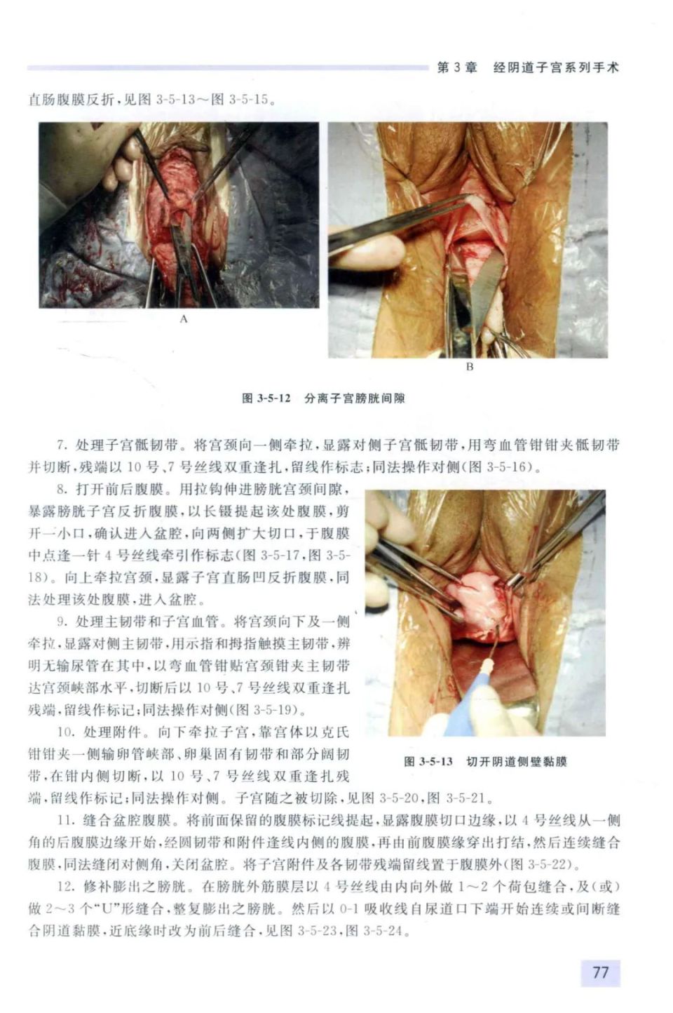 经阴子宫全切除及阴道前后壁修补(图谱)