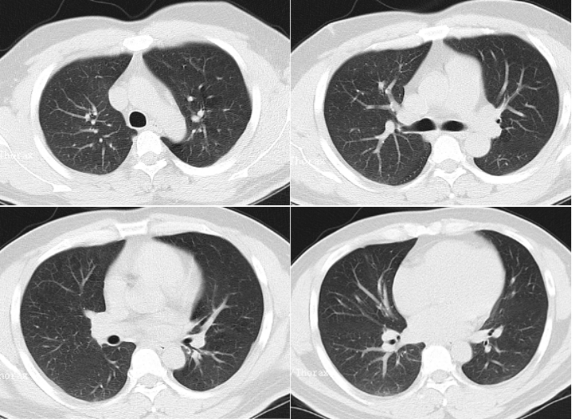 从6个典型案例,看"疑难重症肺部感染"的综合判断和处理!