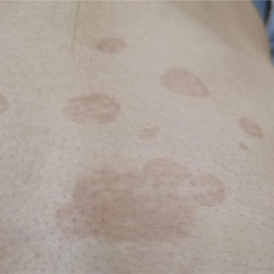 【儿研所儿医说】夏日出汗多,皮肤"花斑"需警惕