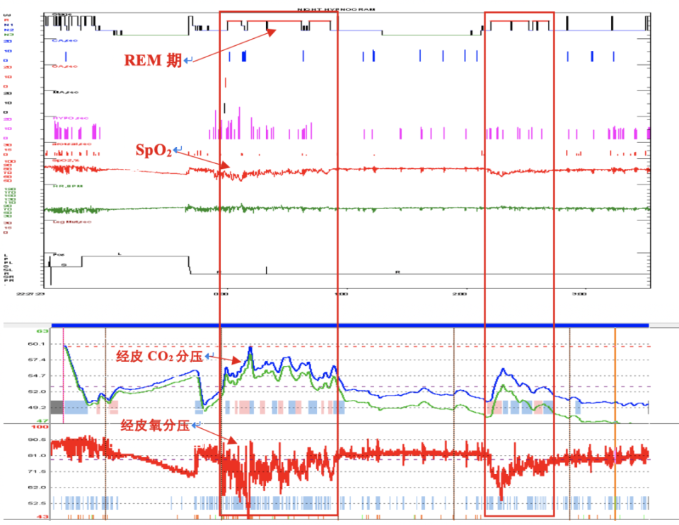 呼吸机怎么打开Ⅱ型呼吸衰竭又陷诊断困局……当室速撞上呼吸“牢笼”，如何通过破解隐匿的神经肌肉密码打开思路，拨云见日？丨疑案探密（161）_https://www.jmylbn.com_新闻资讯_第5张