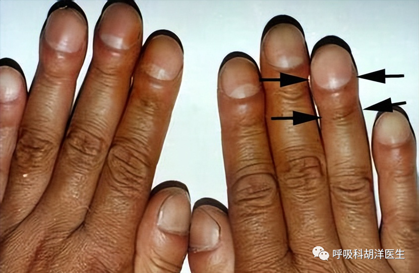 也就是偏扁平的形状,如果前后径明显突出和左右径趋同,要当心桶状胸的