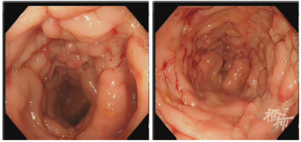 15岁女孩总是拉肚子检查发现肠子内长满了鹅卵石这种病好发于青壮年