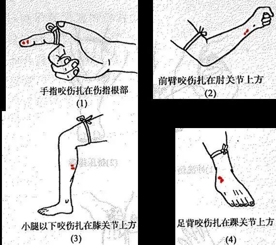 用止血帶或橡膠帶(緊急情況下可使用鞋帶,腰帶,手絹或撕開的衣服)等在