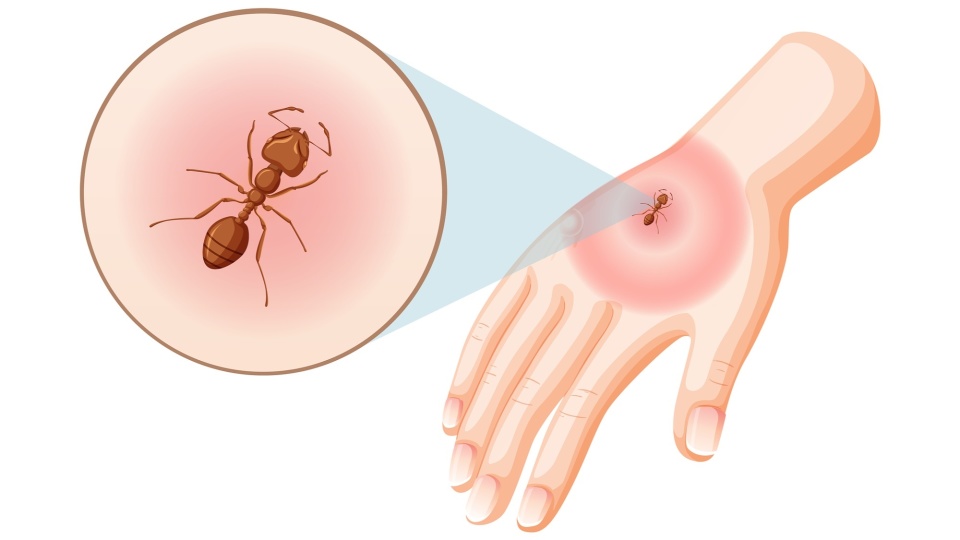 蚂蚁为什么咬人