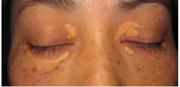 EV是什么针第一批90后已经高血脂！打一针管半年的降脂新方法来啦_https://www.jmylbn.com_新闻资讯_第5张