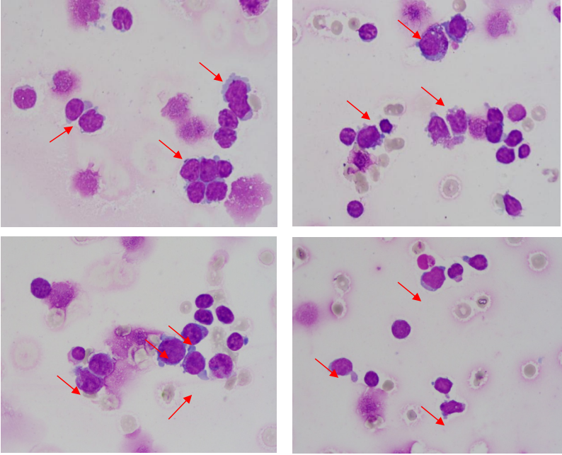 ①取房水送检验科进行常规细胞学检查,涂片瑞吉氏染色查见淋巴瘤细胞