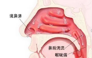 扁桃体肿大原因图片