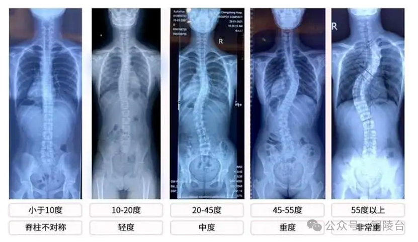【健康有约】关注儿童青少年第三大疾病——脊柱侧弯