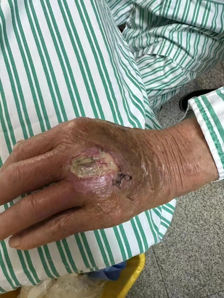 被狗咬了一口杭州大伯伤口流脓高烧不退为啥打了狂犬病疫苗仍遭罪