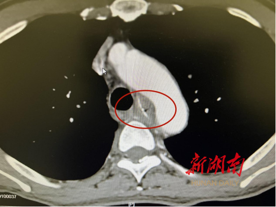 手術開始後,可見距門齒26cm處有一片狀魚刺嵌入食管壁內,與心臟同頻