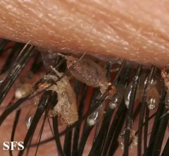 床虱大爆发藏在床垫坐垫沙发里的危害我们能做些什么