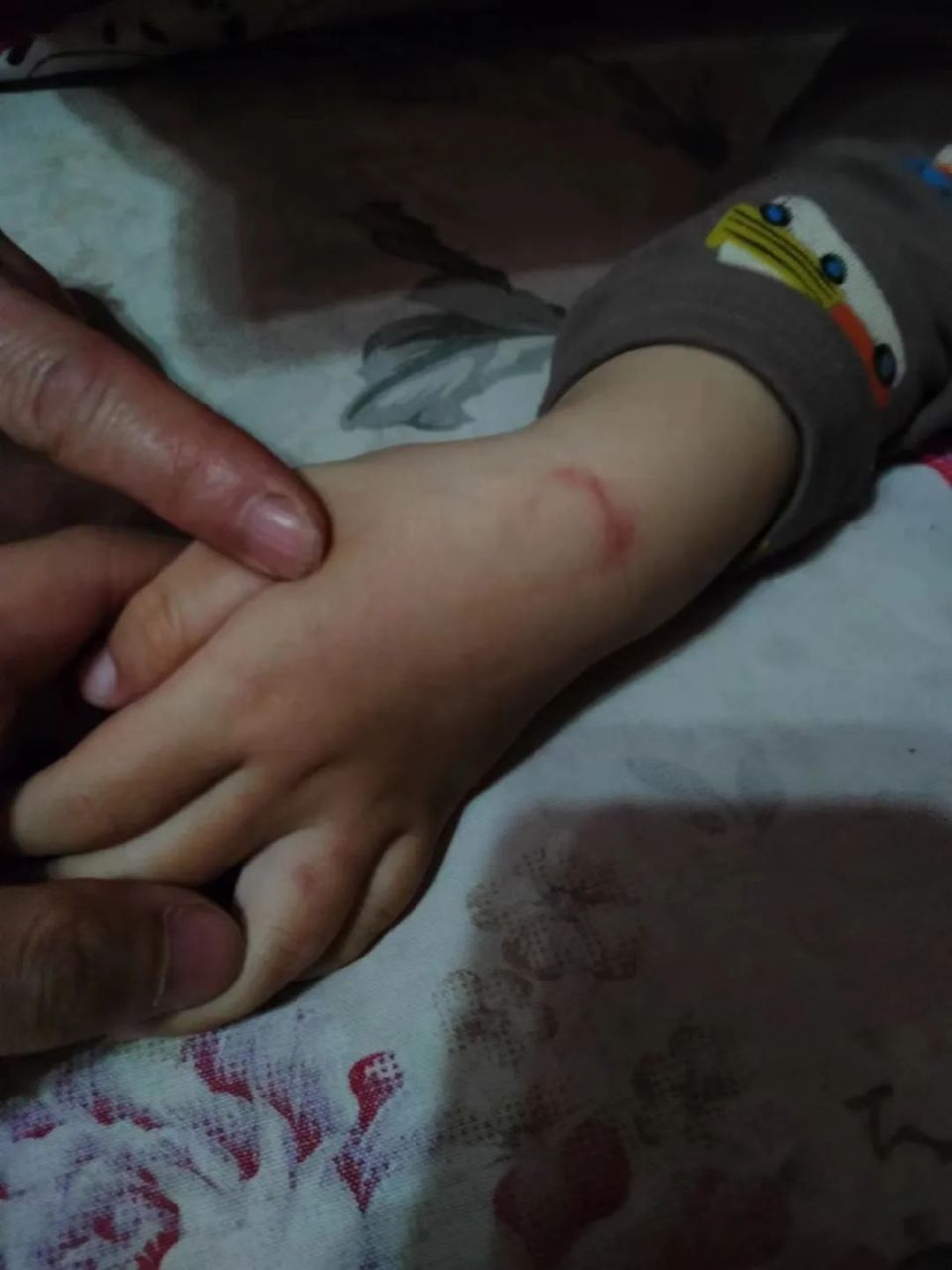 幼儿手臂现多处咬痕家长怀疑孩子遭幼师啃咬教育局已介入调查