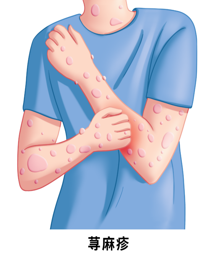 荨麻疹小科普