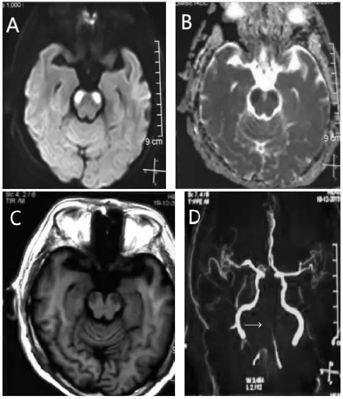 双侧大脑脚梗死——这样的mri,看过一次就不会忘记!
