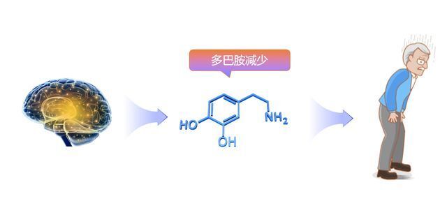 聊聊左旋多巴与它的"铁粉们"_腾讯新闻
