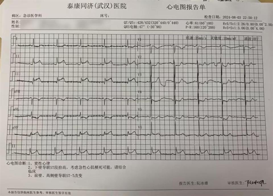 回旋支闭塞心电图表现图片