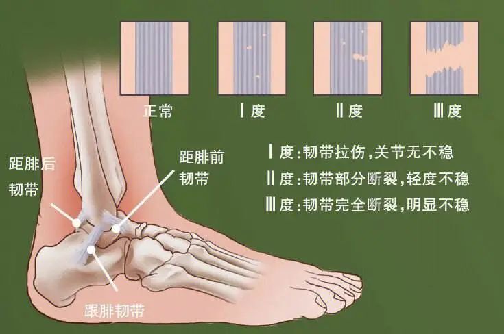 从踝关节解剖学角度来看,踝关节内侧的三角韧带面积大,纤维细密且强韧