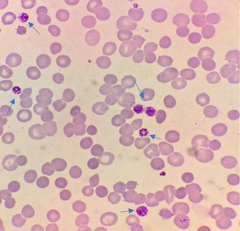 如何从散点图和直方图中"侦察"到大血小板的存在